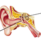 Illustration for article titled My Cyborg Ear: How a Surgeon and Titanium Cured My Lifelong Deafness
